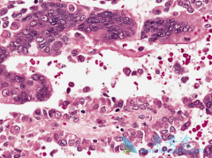 肾癌早期的治疗