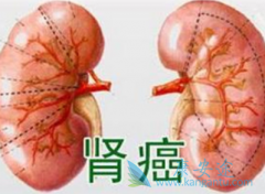 诱发肾癌出现的因素有哪些?