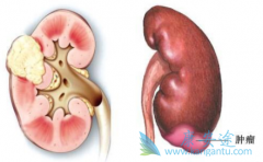 关于治疗肾癌的一些方法