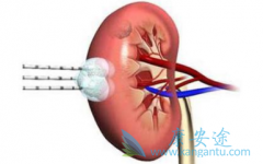 了解肾癌的特点以及它的一些症状
