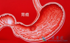 导致胃癌的因素有哪些呢